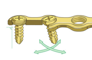 locking plate vs non locking plate