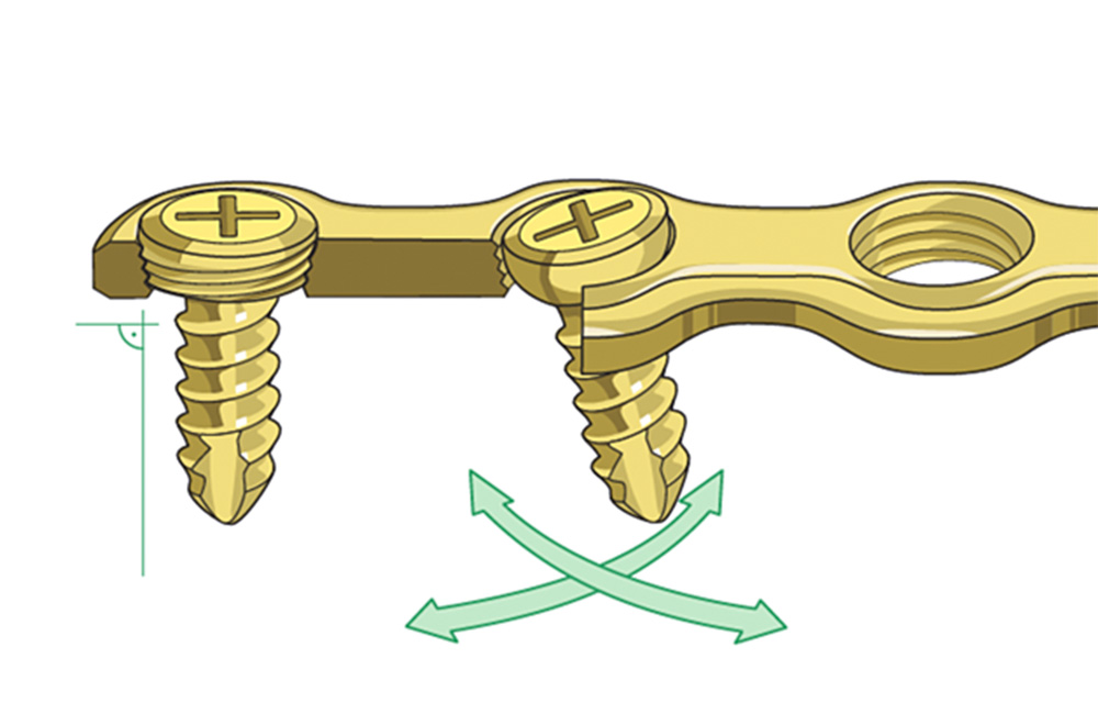 locking plate vs non locking plate